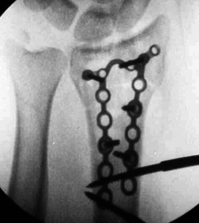 Radius, Distal:  Synthes Pi Plate (Implant 245)